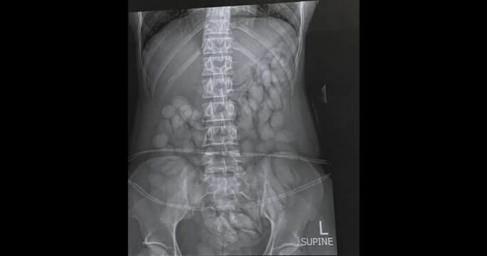 Police in South Africa arrest 'drug mule' with cocaine bullets inside stomach