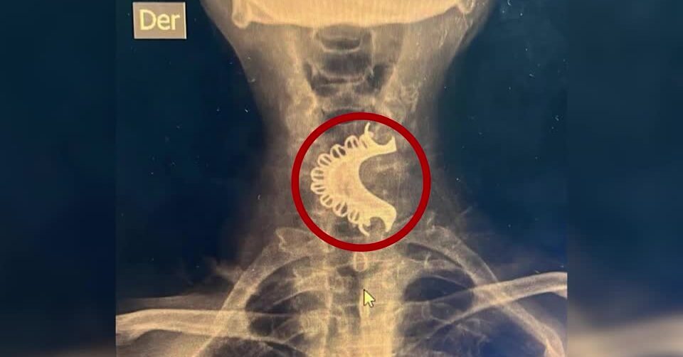 X-ray showing dentures accidentally swallowed by elderly man in Peru