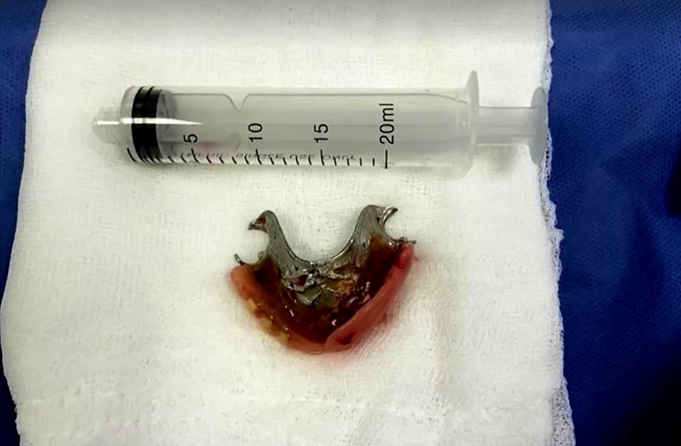 dentures accidentally swallowed by elderly man in Peru