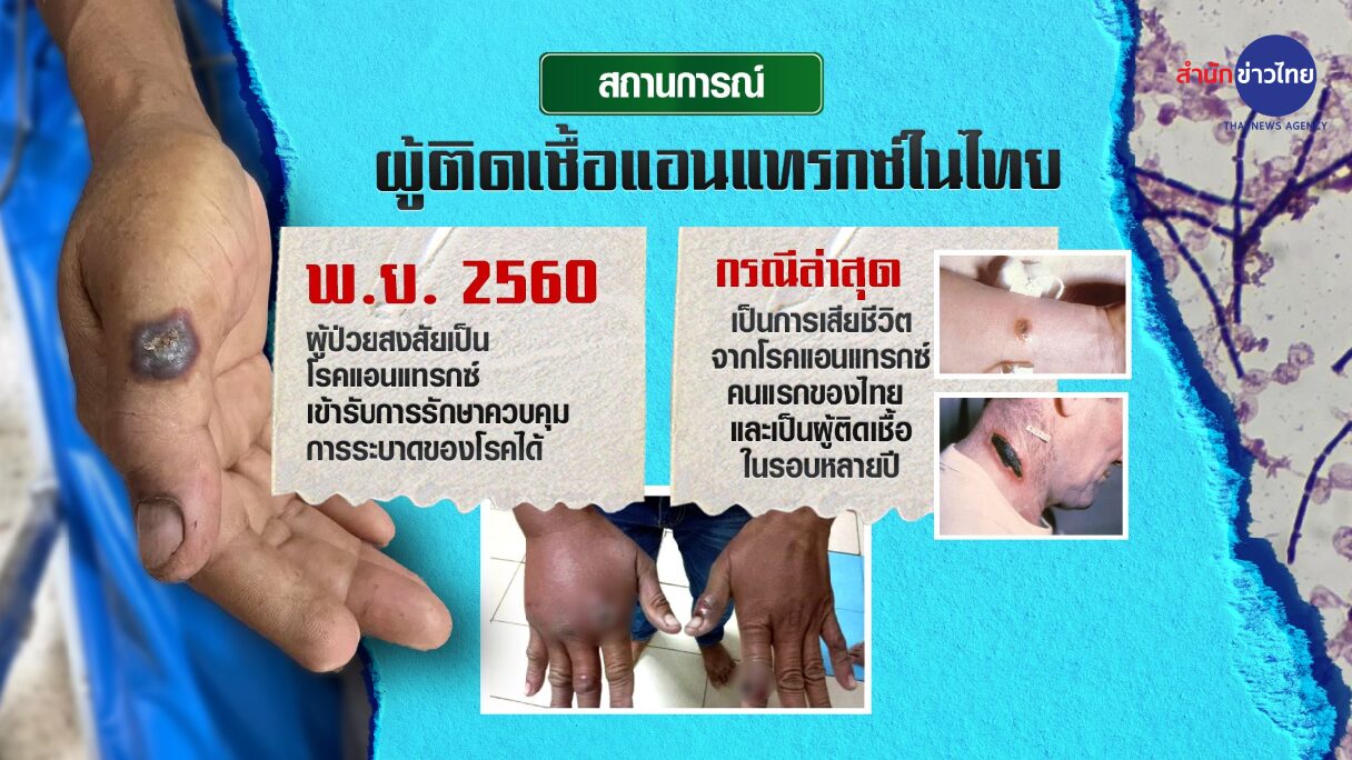 ติดเชื้อแอนแทรกซ์