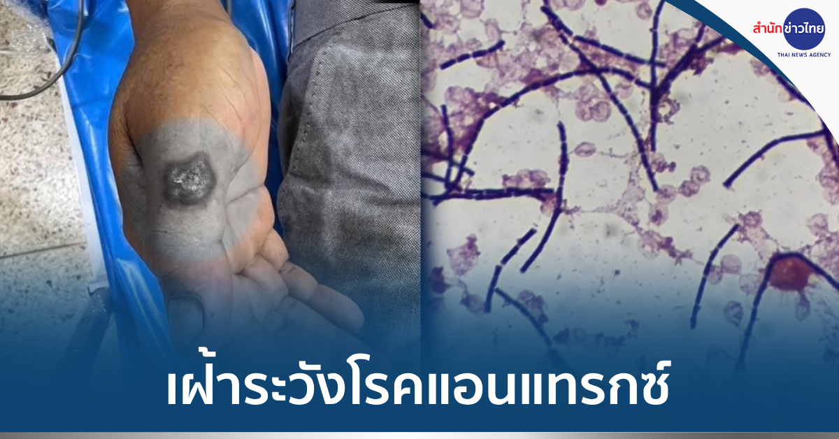 โรคแอนแทรกซ์
